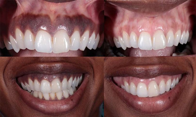 Depigmentation Of Gums