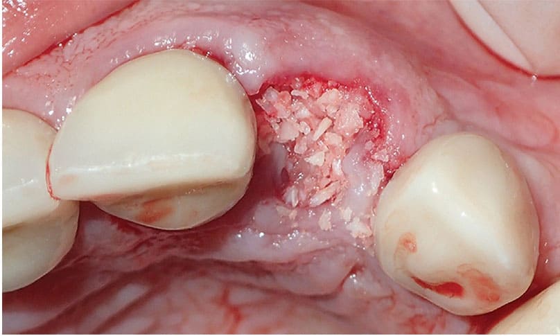 Gum And Bone Grafting